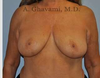 Procedure before and after - after