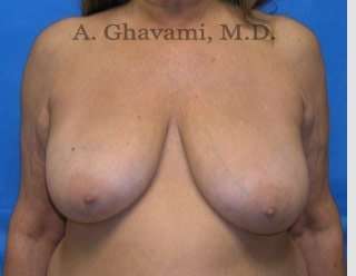 Procedure before and after - before