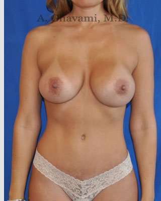 Mommy Makeover before and after - after