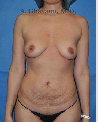 Mommy Makeover before and after - before