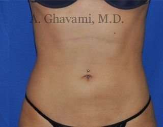 Liposuction before and after - after