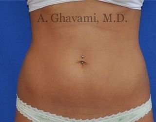 Liposuction before and after - before