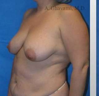 Procedure before and after - before
