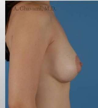 Procedure before and after - after