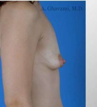 Procedure before and after - before