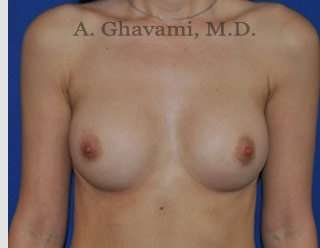 Procedure before and after - after