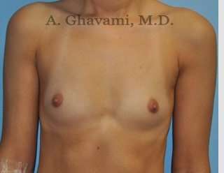 Procedure before and after - before