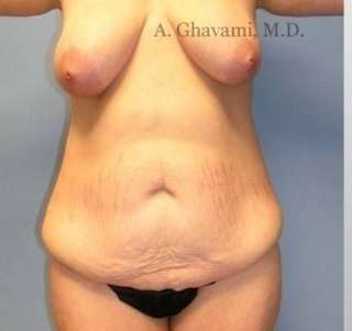 Mommy Makeover before and after - before