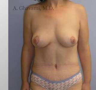 Mommy Makeover before and after - after