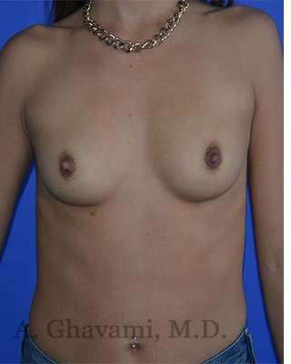 Procedure before and after - before