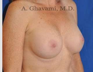 Procedure before and after - after