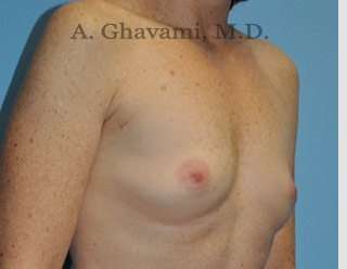 Procedure before and after - before