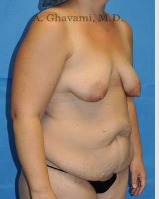 Mommy Makeover before and after - before