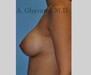 Procedure before and after - after
