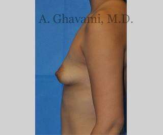 Procedure before and after - before
