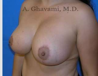 Procedure before and after - after