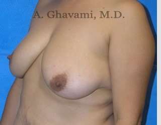 Procedure before and after - before