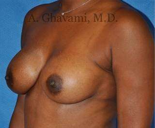 Procedure before and after - after