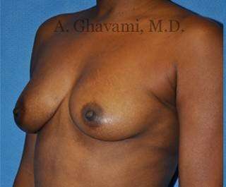 Procedure before and after - before