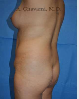 Mommy Makeover before and after - before