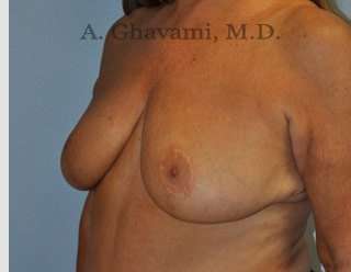 Procedure before and after - after