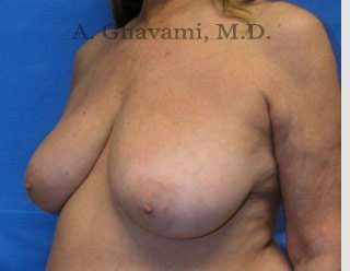Procedure before and after - before