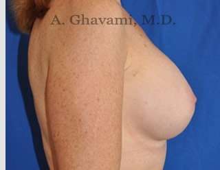 Procedure before and after - after