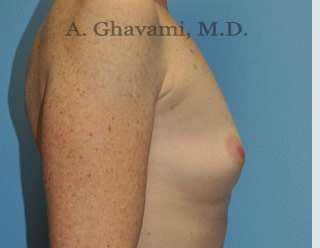 Procedure before and after - before