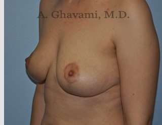 Procedure before and after - after