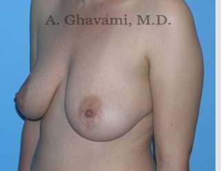Procedure before and after - before