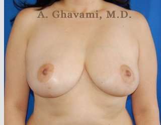 Procedure before and after - after