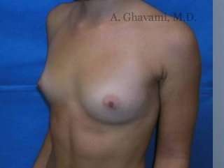 Procedure before and after - before