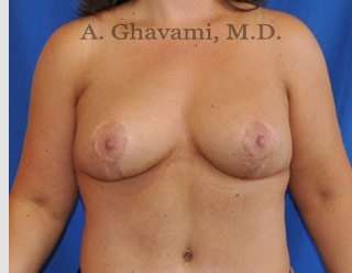 Procedure before and after - after