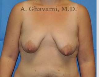 Procedure before and after - before