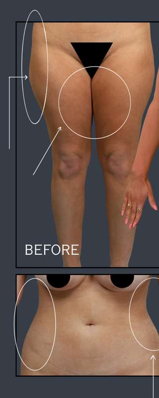 Liposuction before and after - before