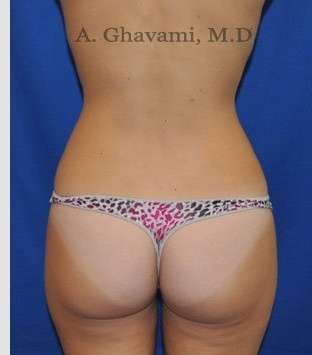 Liposuction before and after - after