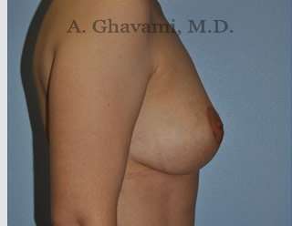 Procedure before and after - after