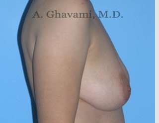 Procedure before and after - before