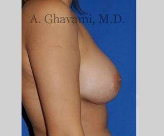 Procedure before and after - after