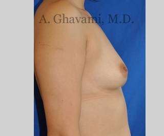 Procedure before and after - before