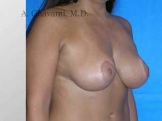 Procedure before and after - after