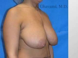 Procedure before and after - before
