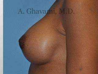 Procedure before and after - after