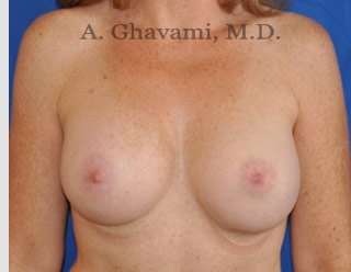 Procedure before and after - after