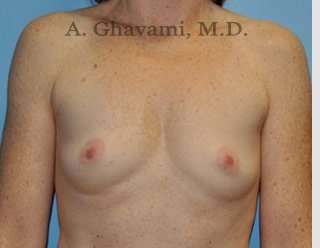 Procedure before and after - before