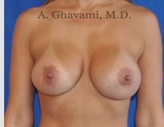 Procedure before and after - after