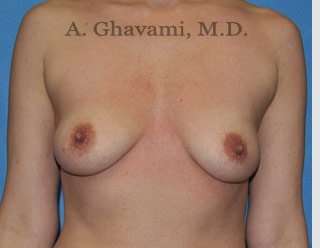 Procedure before and after - before