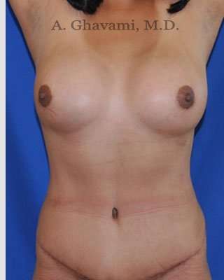 Mommy Makeover before and after - after