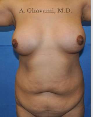 Mommy Makeover before and after - before