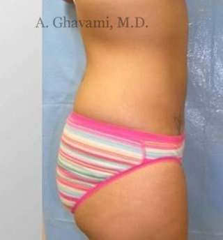 Liposuction before and after - after
